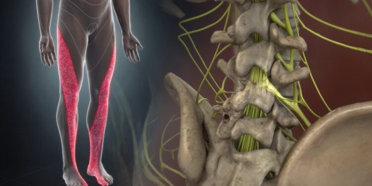 بهترین ورزش برای درد سیاتیک و دیسک کمر: آموزش 10 حرکت مؤثر