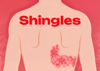 بیماری زونا چیست؟ علل، علائم و درمان