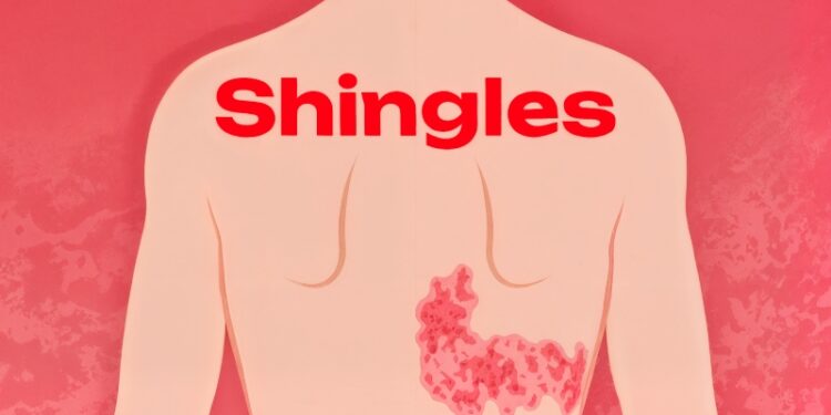 بیماری زونا چیست؟ علل، علائم و درمان