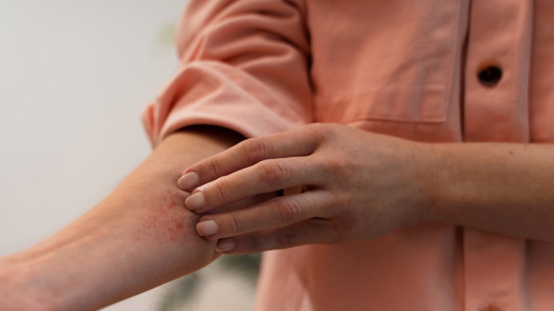 علائم و نشانه های زونا