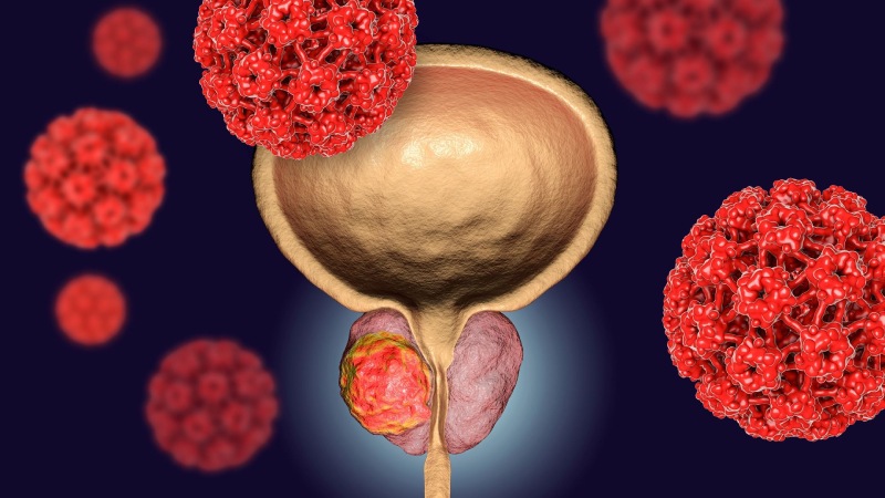 علل و دلایل ایجاد سرطان پروستات