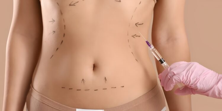لیپوماتیک چیست و چه عوارضی دارد؟ همه چیز درباره عمل حذف چربی های اضافه