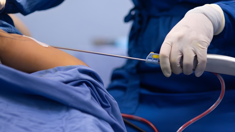 مراحل انجام جراحی لیپوماتیک